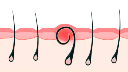 How to Prevent Ingrown Hairs