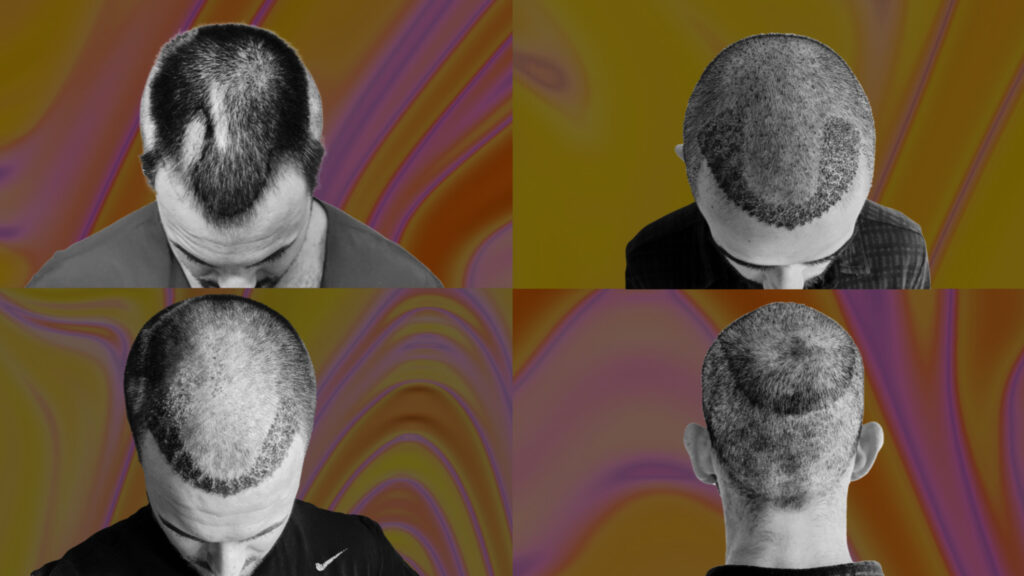 Hair Transplants Explained