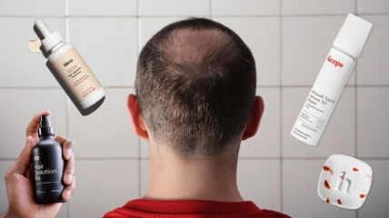 Minoxidil for Hair Loss