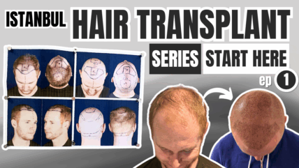 Hair Transplant Progress Series: Watch the Procedure + Recovery + Regrowth