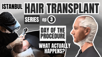 VIDEO: Istanbul Hair Transplant Procedure (Day-Of Details)